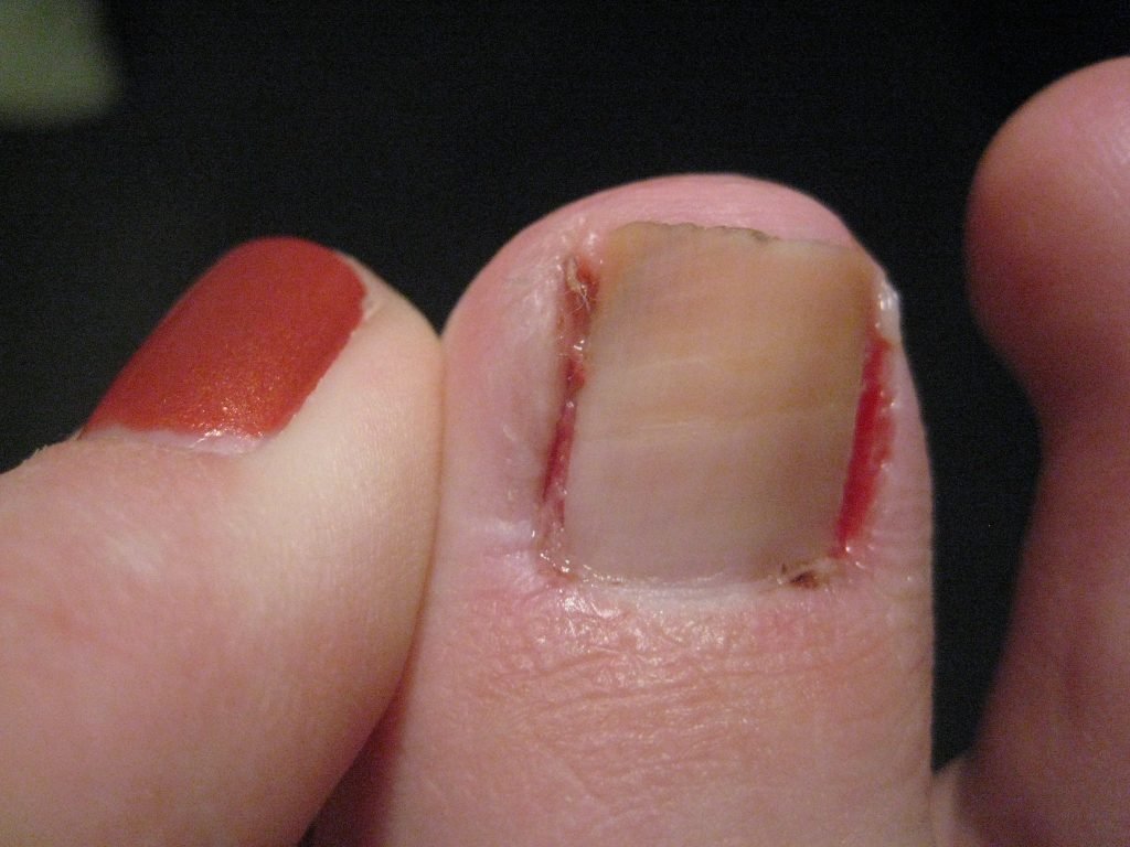 Causes of an Ingrown toenail